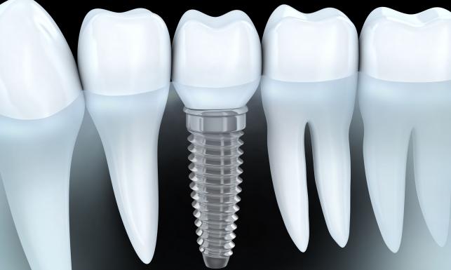 implant zębowy